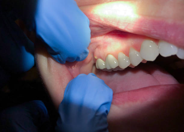 Best Emergency Treatment for Dental Infections or Abscesses in St Andrews, SC