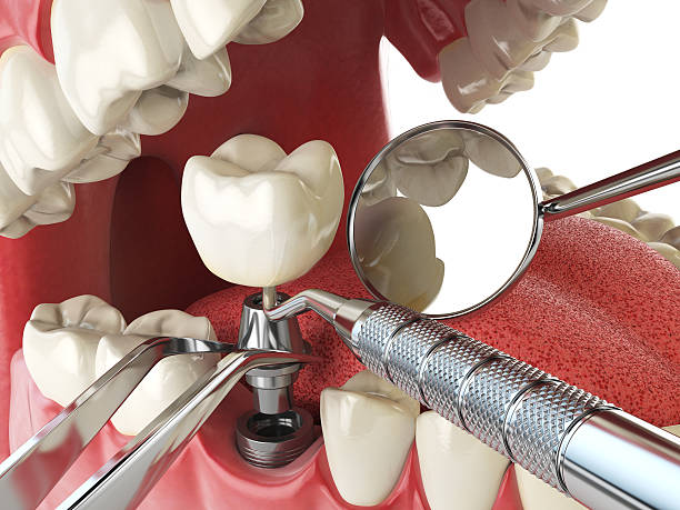 Best Emergency Dental Care for Broken or Chipped Teeth in St Andrews, SC
